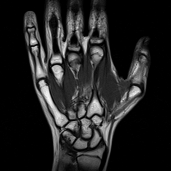 MRI Left Hand